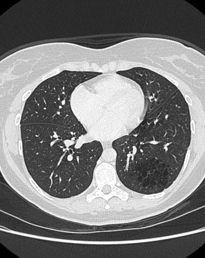 Bronchial atresia (Radiopaedia 50007-55297 Axial lung window 67).jpg