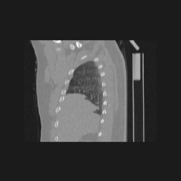 File:Bronchial atresia (Radiopaedia 60685-68439 Sagittal lung window 12).jpg