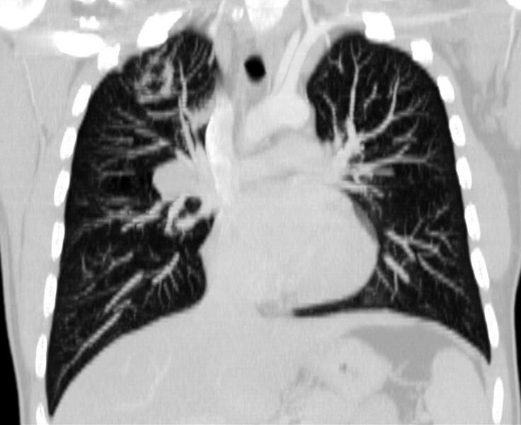 File:Bronchocele (Radiopaedia 12104-12460 Coronal lung window 9).jpg