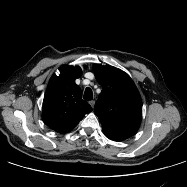 File:Bronchogenic carcinoma with L1 vertebra metastasis (Radiopaedia 9096-9805 Axial C+ delayed 5).jpg