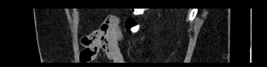 Buried bumper syndrome - gastrostomy tube (Radiopaedia 63843-72575 Sagittal Inject 19).jpg