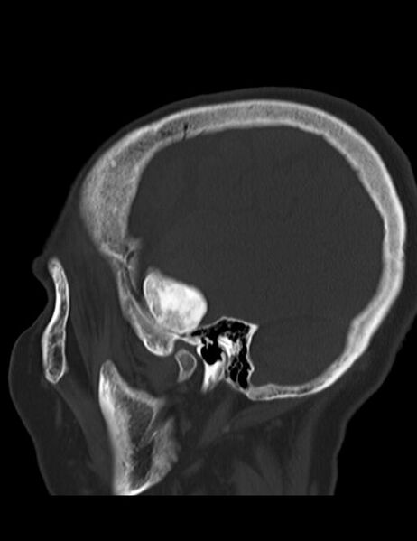 File:Burnt-out meningioma (Radiopaedia 51557-57337 Sagittal bone window 8).jpg