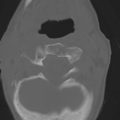 C2 fracture with vertebral artery dissection (Radiopaedia 37378-39199 Axial bone window 15).png