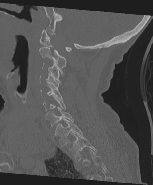 File:C2 fracture with vertebral artery dissection (Radiopaedia 37378-39199 Sagittal bone window 49).png