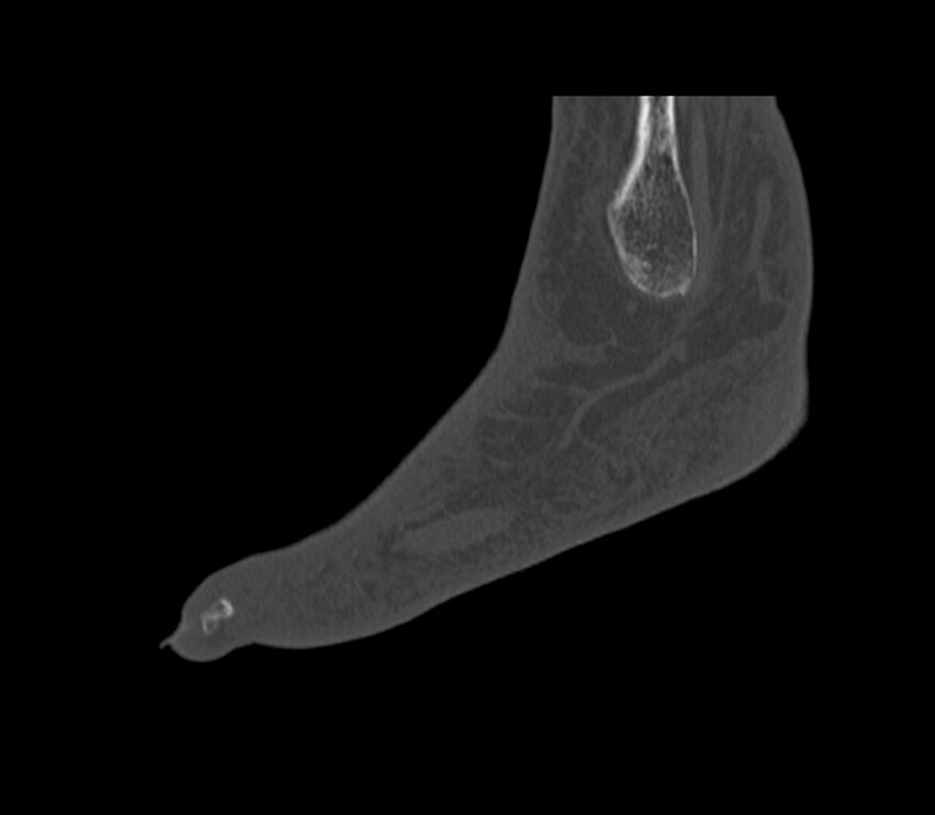 Calcaneal tuberosity avulsion fracture (Radiopaedia 22649-22668 Sagittal bone window 5).jpg