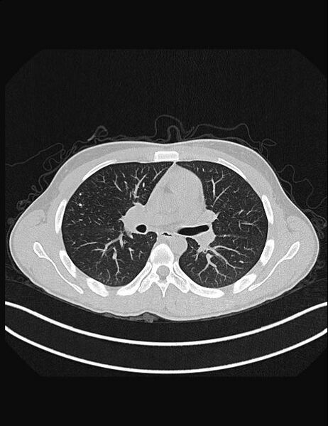 File:Calcifying pulmonary metastases (Radiopaedia 33359-34396 Axial lung window 28).jpg