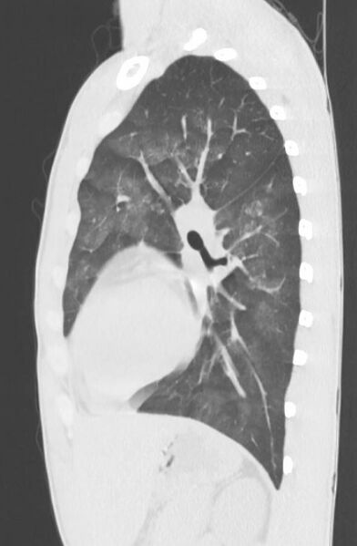 File:Cannabis-induced diffuse alveolar hemorrhage (Radiopaedia 89834-106946 Sagittal lung window 92).jpg