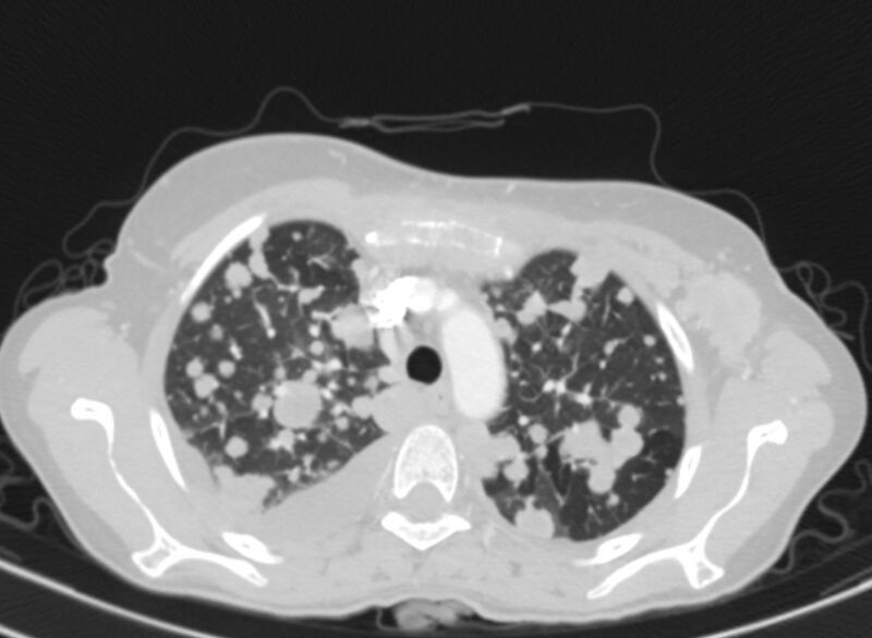 File:Cannonball metastases from breast cancer (Radiopaedia 91024-108569 Axial lung window 21).jpg
