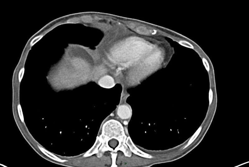 File:Carcinoid mesenteric tumor complicated by chylous ascites (Radiopaedia 76312-87953 A 3).jpg