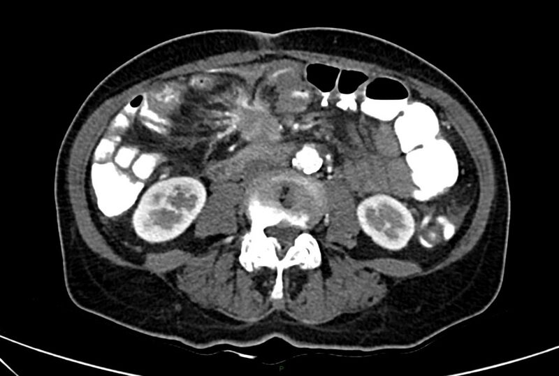 File:Carcinoid mesenteric tumor complicated by chylous ascites (Radiopaedia 76312-88926 A 38).jpg