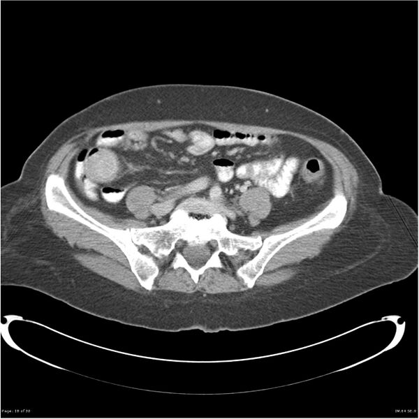 File:Carcinoid tumor of the ileum with metastasis to orbit (Radiopaedia 28165-28425 A 18).jpg