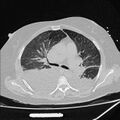 Cardiogenic pulmonary edema (Radiopaedia 29213-29609 Axial lung window 38).jpg
