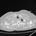 Cardiogenic pulmonary edema (Radiopaedia 29213-29609 Axial lung window 4).jpg