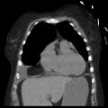 Cardiogenic pulmonary edema (Radiopaedia 29213-29609 Coronal non-contrast 10).jpg