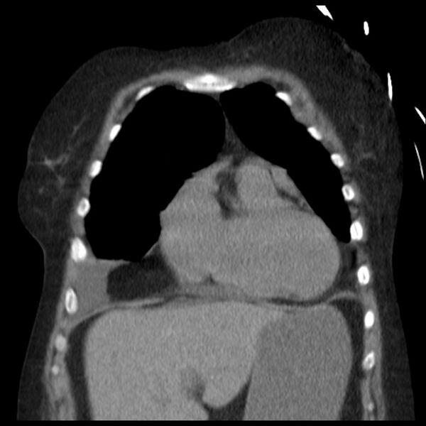 File:Cardiogenic pulmonary edema (Radiopaedia 29213-29609 Coronal non-contrast 10).jpg