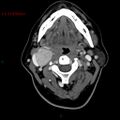 Carotid body tumor (Radiopaedia 20564-20462 B 1).jpg