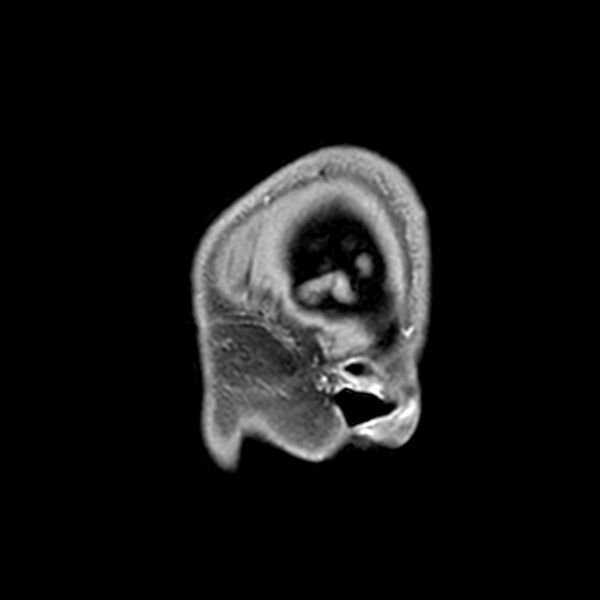 File:Central neurocytoma (Radiopaedia 79320-92380 Sagittal T1 18).jpg