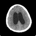 Cerebellar abscess secondary to mastoiditis (Radiopaedia 26284-26412 Axial non-contrast 111).jpg