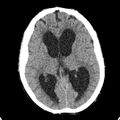 Cerebellar abscess secondary to mastoiditis (Radiopaedia 26284-26412 Axial non-contrast 81).jpg