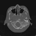 Cerebellar abscess secondary to mastoiditis (Radiopaedia 26284-26413 Axial bone window 21).jpg