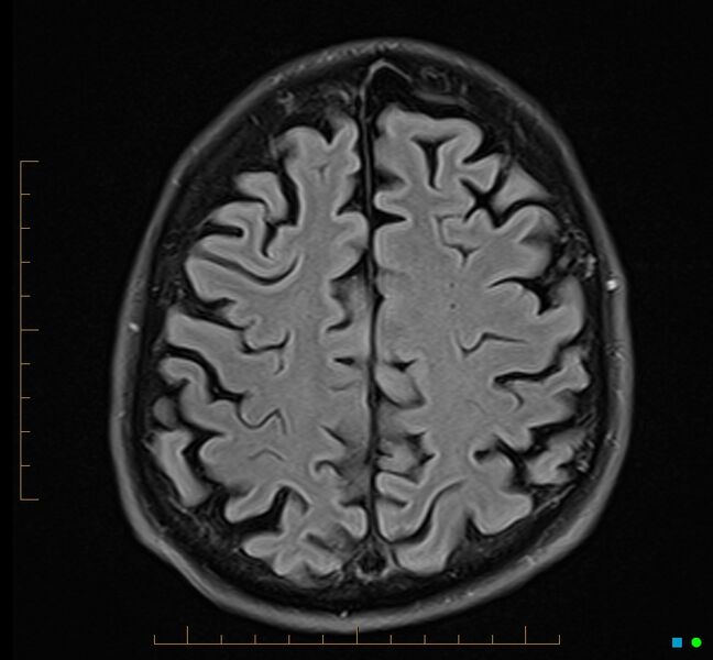 File:Cerebellar gangliocytoma (Radiopaedia 65377-74422 Axial FLAIR 30).jpg