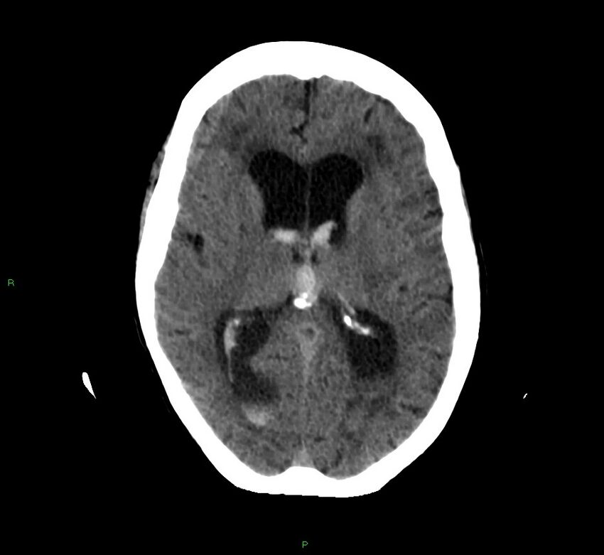 Cerebellar hemorrhage (Radiopaedia 58792-66026 Axial non-contrast 25).jpg