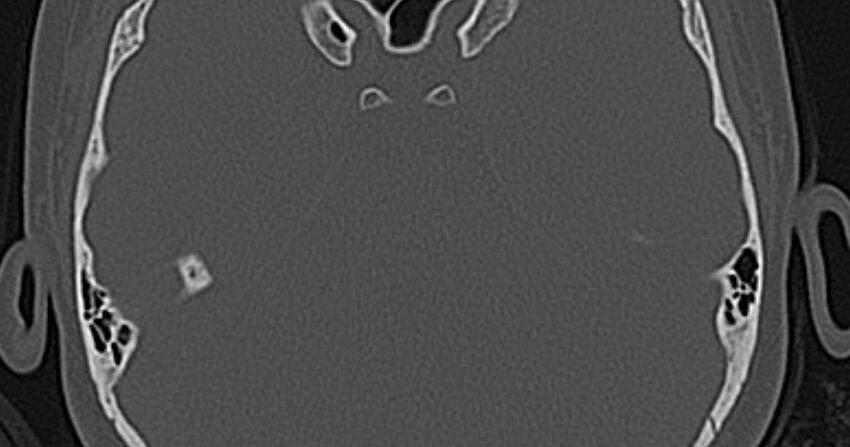 Cerebellopontine angle lipoma (Radiopaedia 57303-64242 Axial bone window 53).jpg