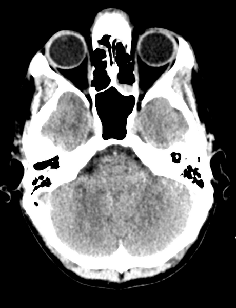 File:Cerebral abscess (Radiopaedia 60342-68008 Axial non-contrast 13).png