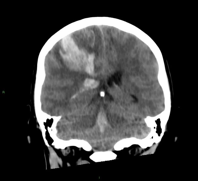 File:Cerebral amyloid angiopathy-associated lobar intracerebral hemorrhage (Radiopaedia 58566-65730 Coronal non-contrast 30).jpg