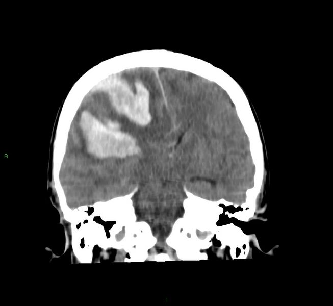 File:Cerebral amyloid angiopathy-associated lobar intracerebral hemorrhage (Radiopaedia 58756-65977 Coronal non-contrast 34).jpg