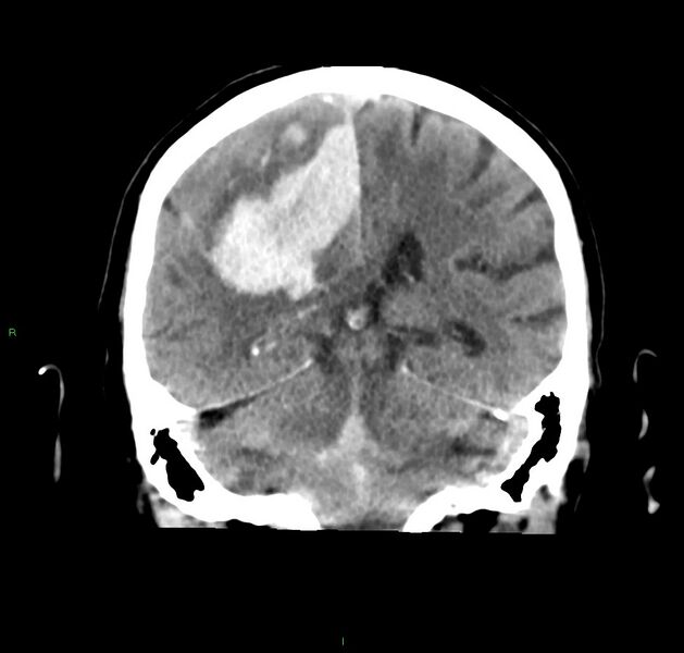 File:Cerebral amyloid angiopathy-associated lobar intracerebral hemorrhage (Radiopaedia 59356-66716 Coronal non-contrast 27).jpg