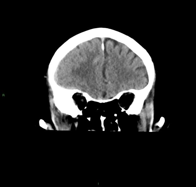 File:Cerebral amyloid angiopathy-associated lobar intracerebral hemorrhage (Radiopaedia 59356-66716 Coronal non-contrast 49).jpg