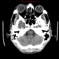 Cerebral and orbital tuberculomas (Radiopaedia 13308-13310 Axial non-contrast 6).jpg