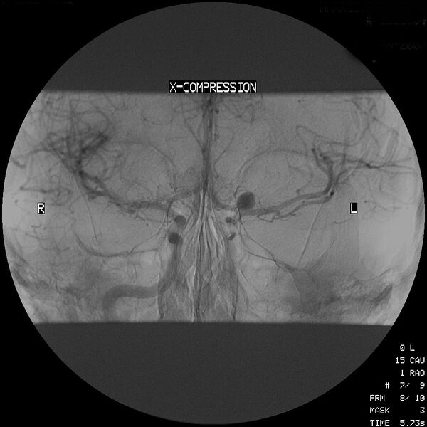 File:Cerebral angiographic projections (Radiopaedia 46308-50712 P 1).jpg