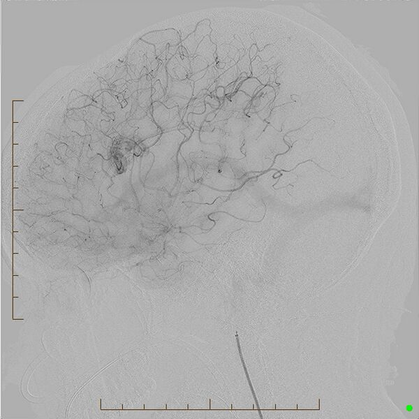 File:Cerebral arteriovenous malformation (AVM) (Radiopaedia 78162-90707 B 13).jpg