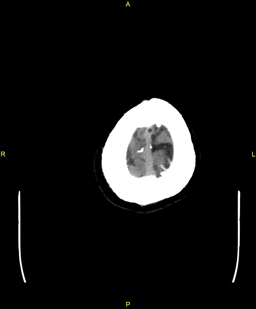 Cerebral autosomal dominant arteriopathy with subcortical infarcts and leukoencephalopathy (CADASIL) (Radiopaedia 86108-102051 Axial non-contrast 110).jpg