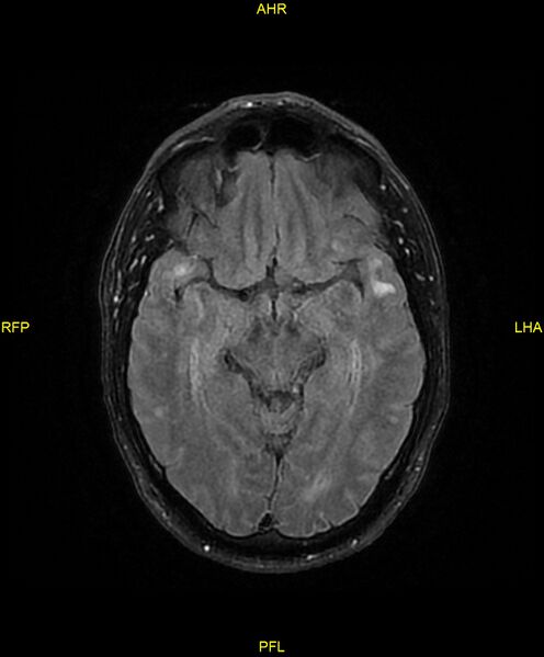 File:Cerebral autosomal dominant arteriopathy with subcortical infarcts and leukoencephalopathy (CADASIL) (Radiopaedia 86108-102054 Axial FLAIR 13).jpg