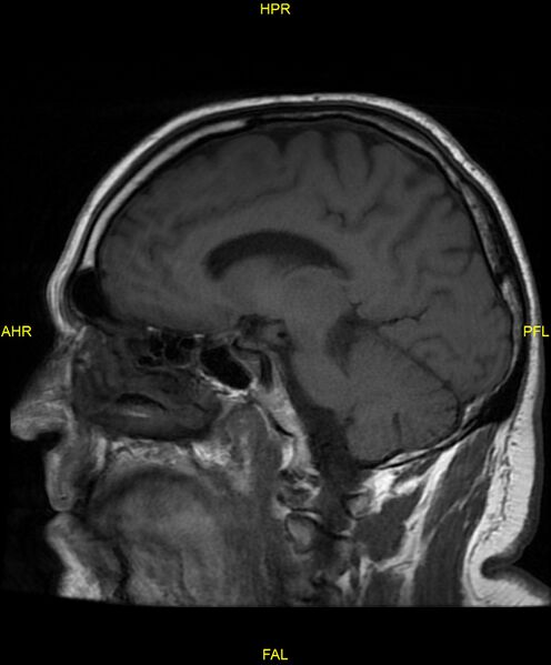 File:Cerebral autosomal dominant arteriopathy with subcortical infarcts and leukoencephalopathy (CADASIL) (Radiopaedia 86108-102054 Sagittal T1 16).jpg