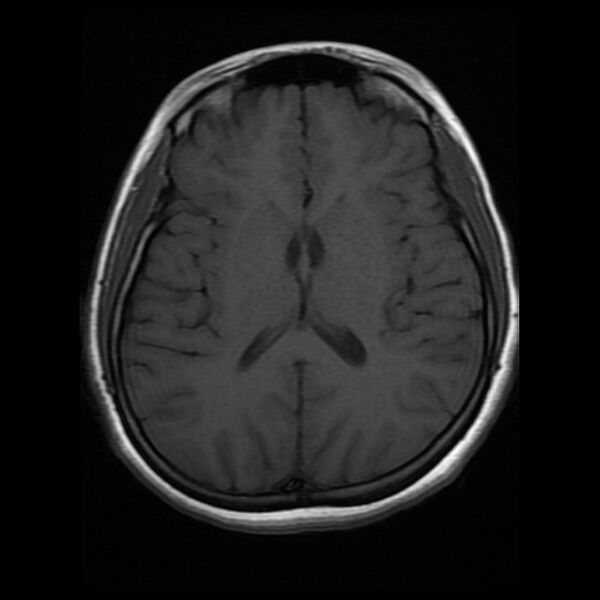 File:Cerebral cavernous malformation (Radiopaedia 44301-47942 Axial T1 12).jpg