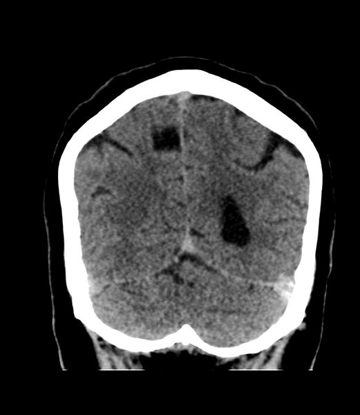 File:Cerebral dural venous sinus thrombosis (Radiopaedia 86514-102575 Coronal non-contrast 41).jpg