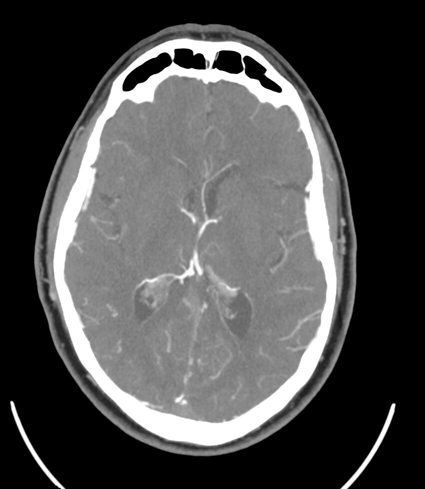 Cerebral dural venous sinus thrombosis (Radiopaedia 86514-102576 A 57).jpg