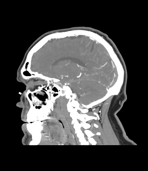 File:Cerebral dural venous sinus thrombosis (Radiopaedia 86514-102576 C 21).jpg