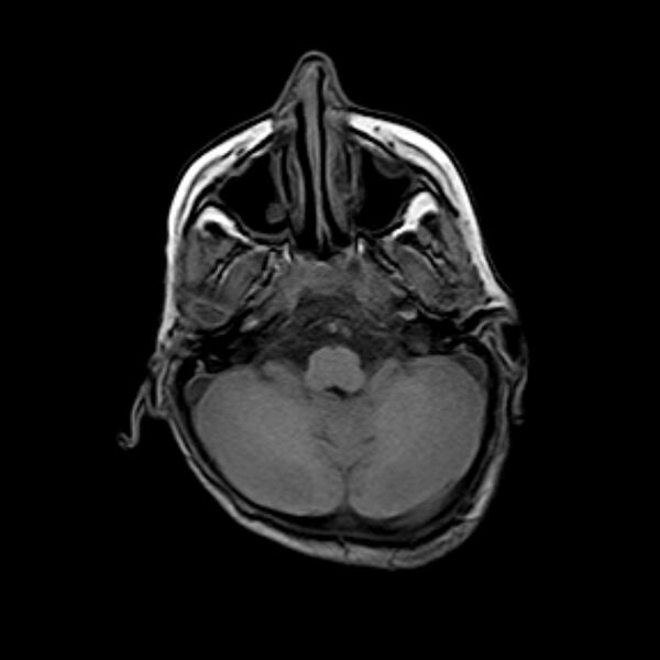 File:Cerebral tuberculoma (Radiopaedia 41152-43932 Axial T1 4).jpg