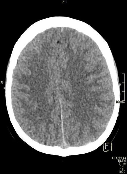 File:Cerebral venous sinus thrombosis (Radiopaedia 91329-108965 Axial non-contrast 35).jpg