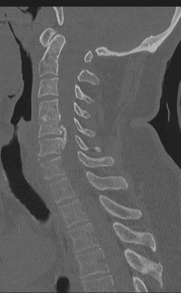 File:Cervical canal stenosis - OPLL and osteophytes (Radiopaedia 47329-51910 Sagittal bone window 37).png