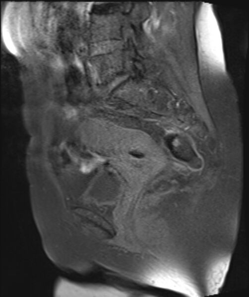 File:Cervical carcinoma (Radiopaedia 88312-104943 Sagittal T1 fat sat 18).jpg