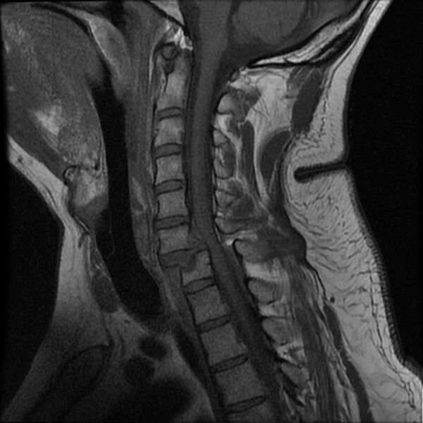 File:Cervical fracture and dislocation with locked facet (Radiopaedia 31837-32781 Sagittal T1 7).jpg