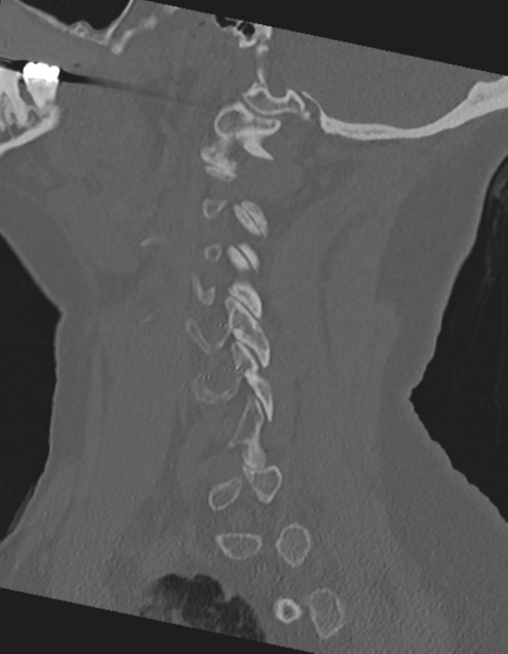 File:Cervical spine ACDF loosening (Radiopaedia 48998-54071 Sagittal bone window 28).png
