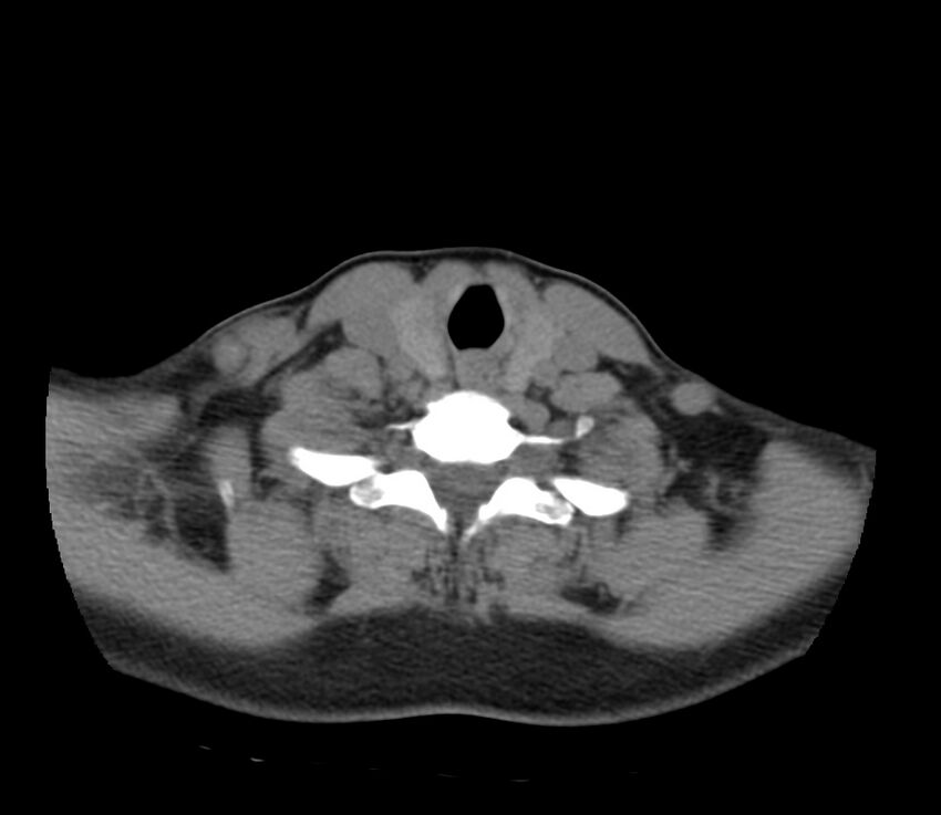Cervical venous malformation (Radiopaedia 22653-22672 Axial non-contrast 43).jpg