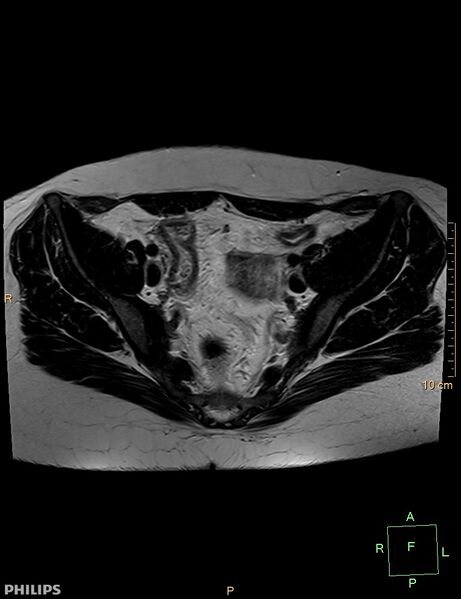 File:Cesarian scar endometriosis (Radiopaedia 68495-78066 Axial T2 8).jpg